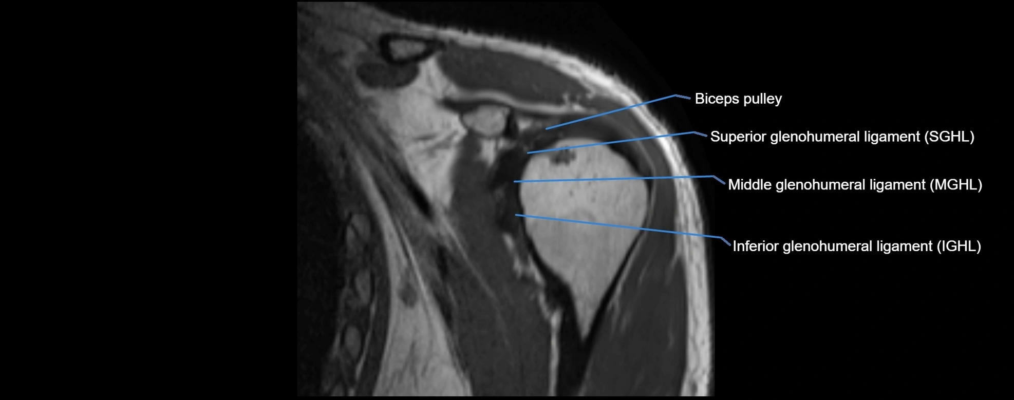 shoulder ligments coronal  cross sectional anatomy 3T MRI AI enhanced radiology image -img-00001-00012.webp